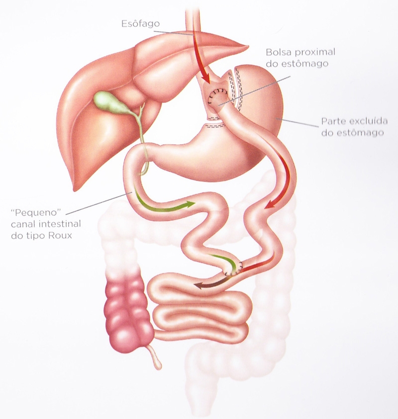 Sleeve Gástrico: O que é e para quem é indicado
